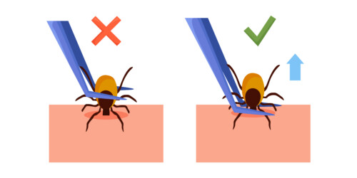Removing encephalitis ticks after bite. How to remove mite. Parasite carrying disease. Tick grabbed into skin, it is removed with tweezers. First aid. Prevention of infections transmitted by mites